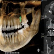 Unikátní OPG a CBCT systém VATECH PaX- i3D Smart