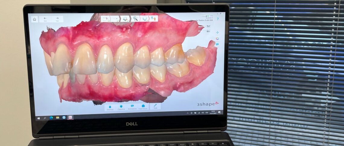 New intraoral scanner