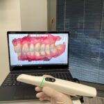 New intraoral scanner